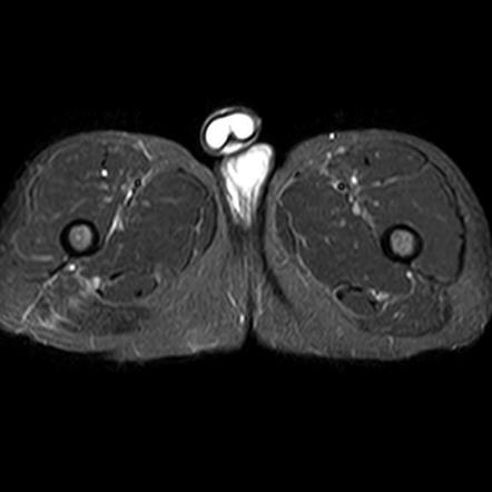 МРТ снимок ишиаса седалищного нерва