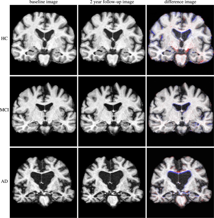 МРТ снимок болезни Альцгеймера