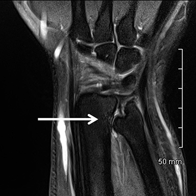 МРТ снимок лучезапястного сустава