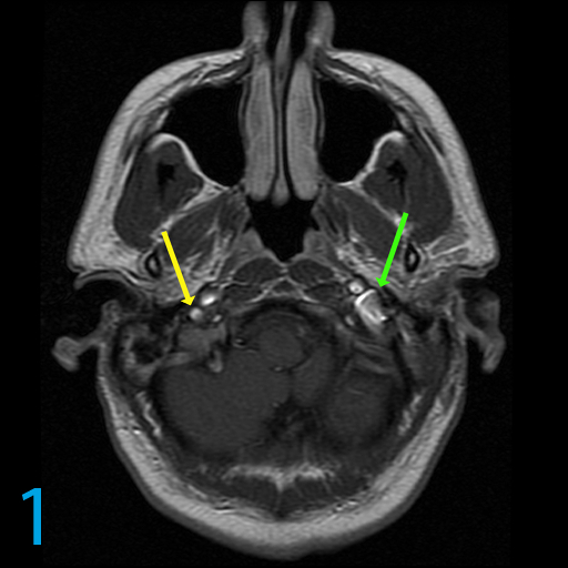 МРТ снимок внутреннего уха