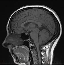 МРТ снимок мозга