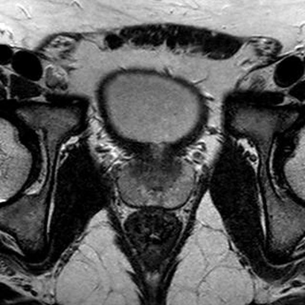 МРТ снимок предстательной железы