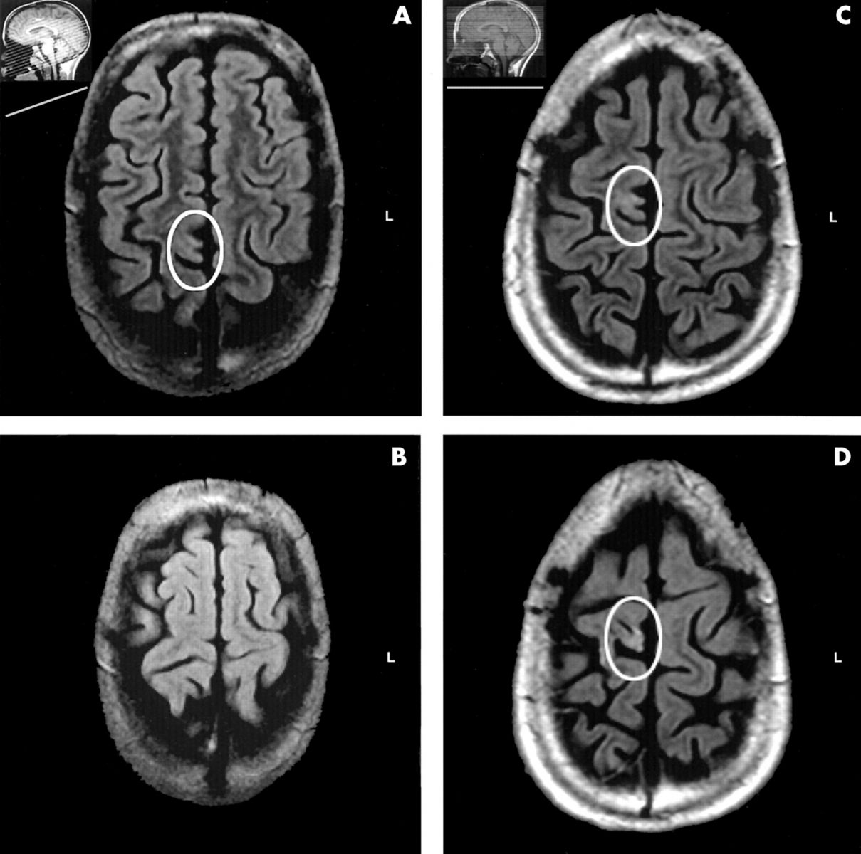 МРТ снимок эпилепсии