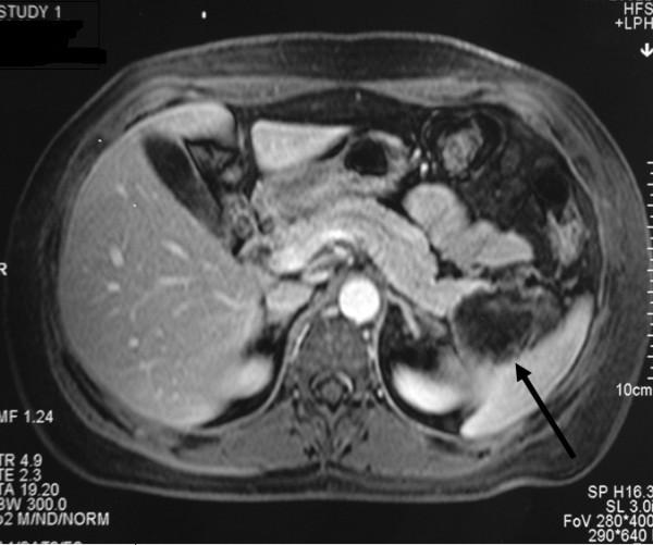 МРТ снимок поджелудочной железы
