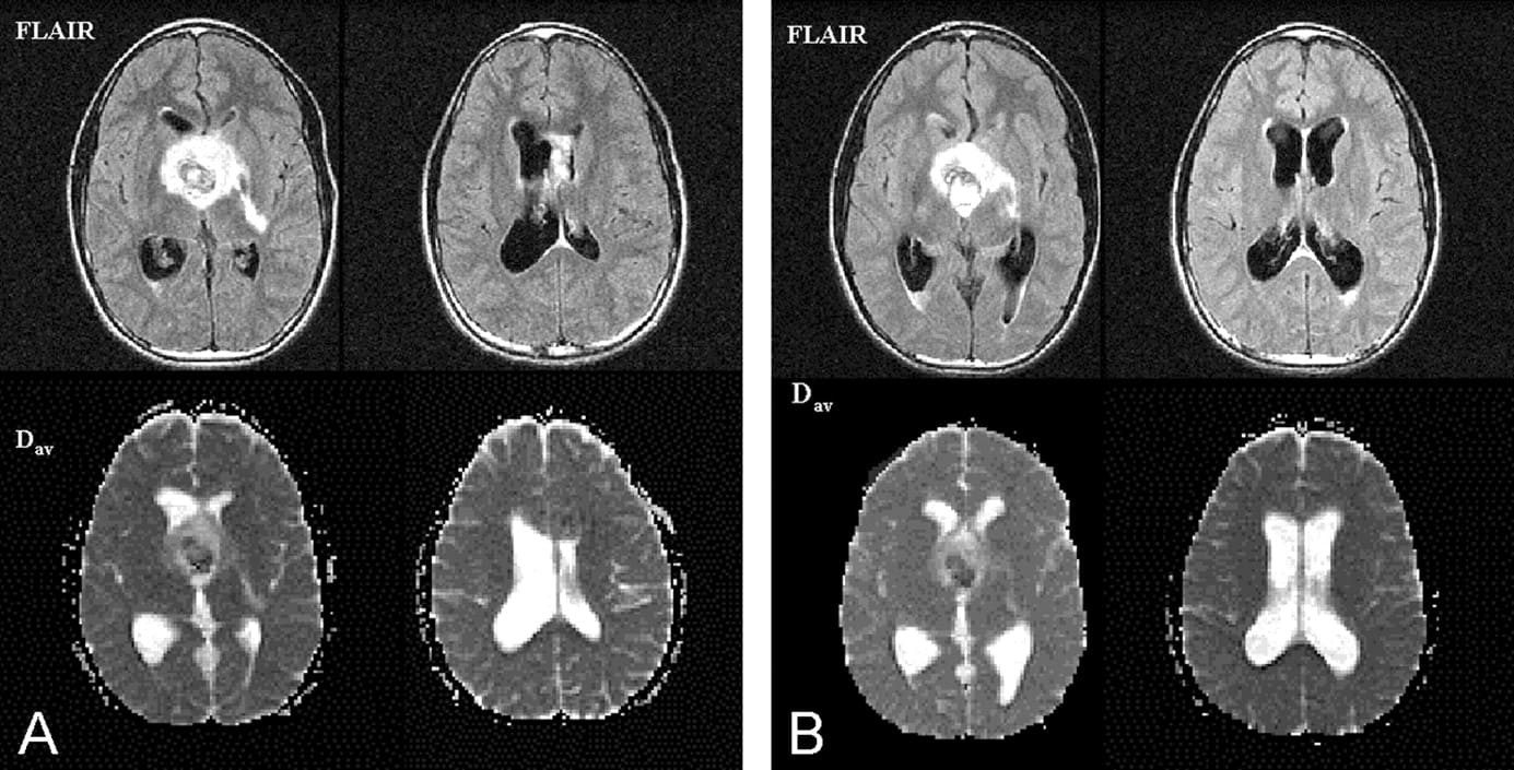Гидроцефалии на МРТ головного мозга - протокол, признаки на МРТ снимках