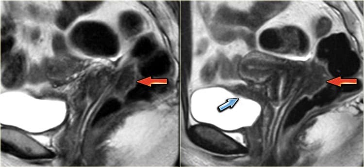 МРТ малого таза при эндометриозе - протокол, признаки на МРТ снимках