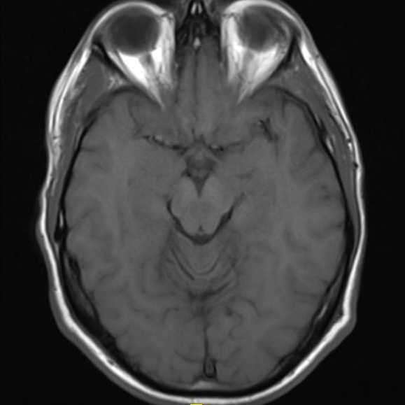 МРТ головного мозга при болезни Паркинсона (паркинсонизме)