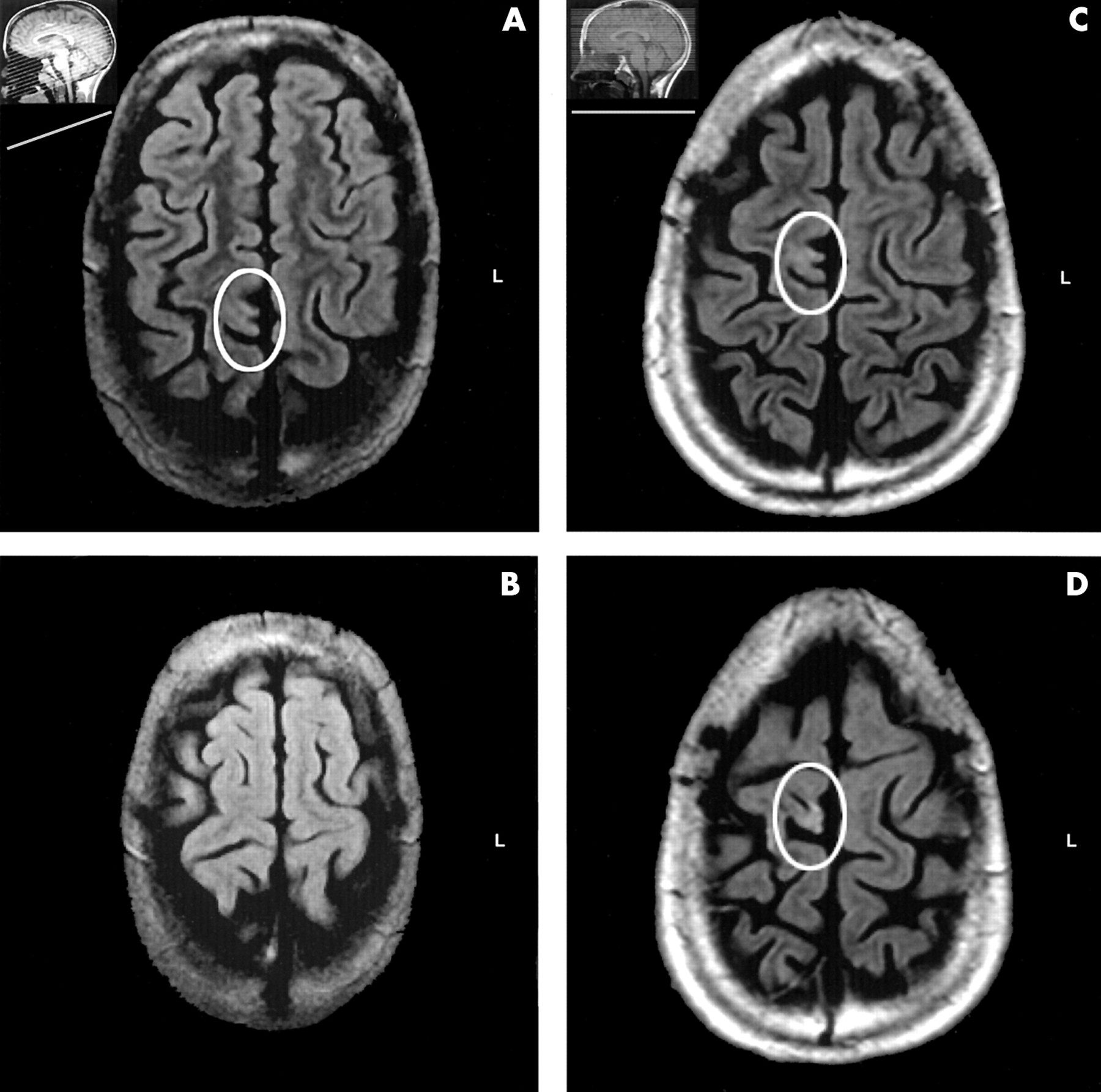 Что покажет МРТ мозга при эпилепсии