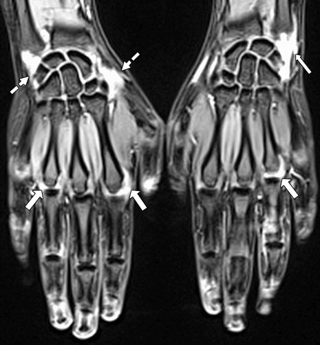 Что покажет МРТ суставов кистей руки и пальцев