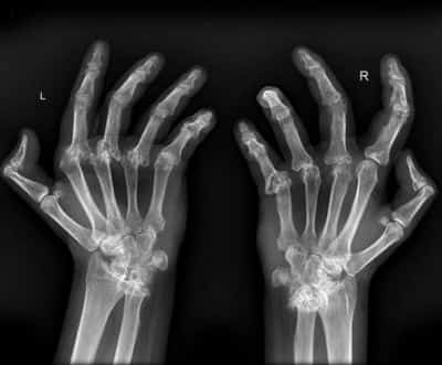 Какой врач лечит врожденную деформацию пальцев рук