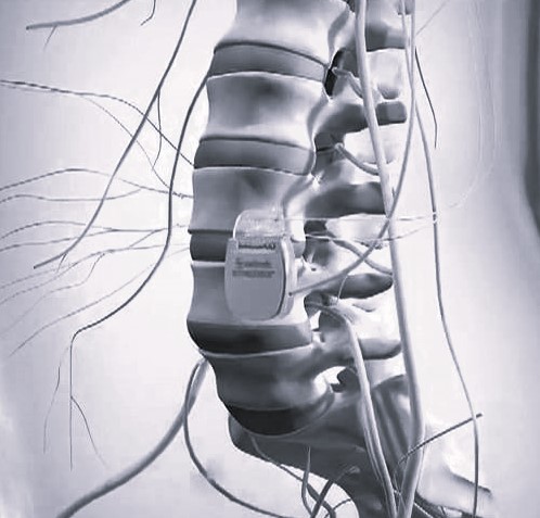 Имплантация стимулятора для нейростимуляции спинного мозга в Санкт-Петербурге