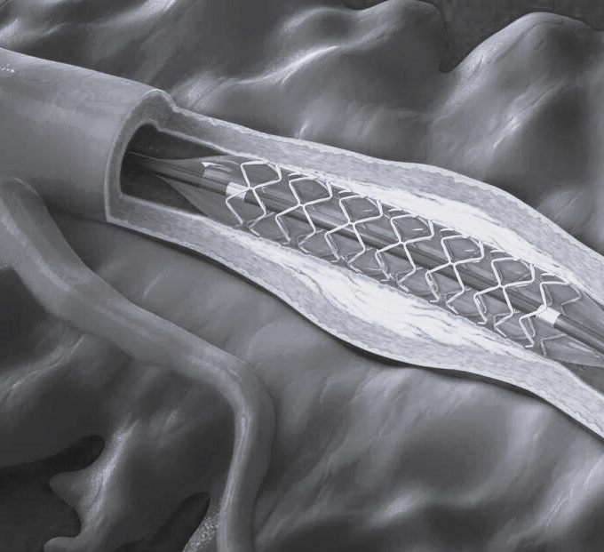 Имплантация поток-отклоняющего стента в Санкт-Петербурге