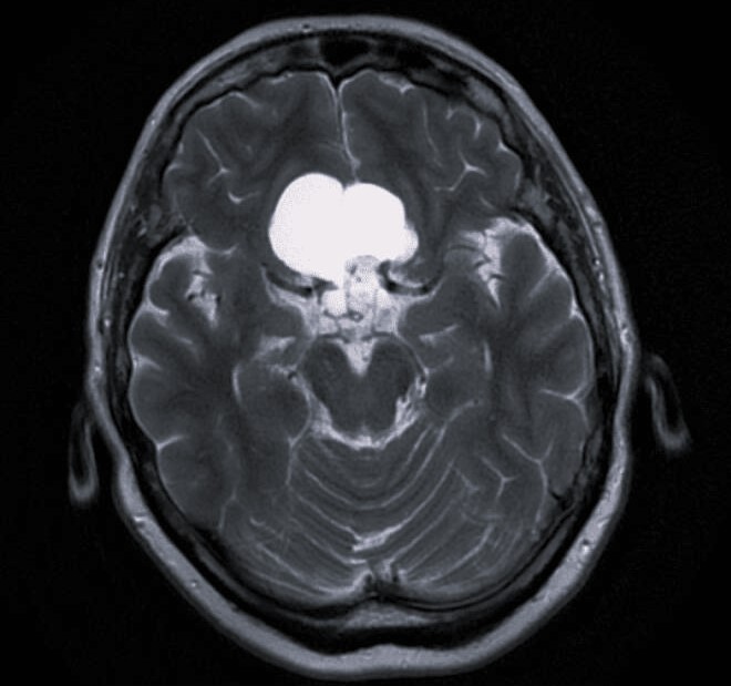 Микрохирургическое удаление краниофарингиомы в Санкт-Петербурге