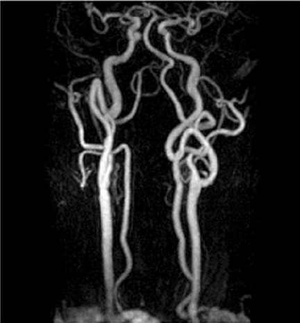 Что покажет МРТ при атеросклерозе сонных артерий