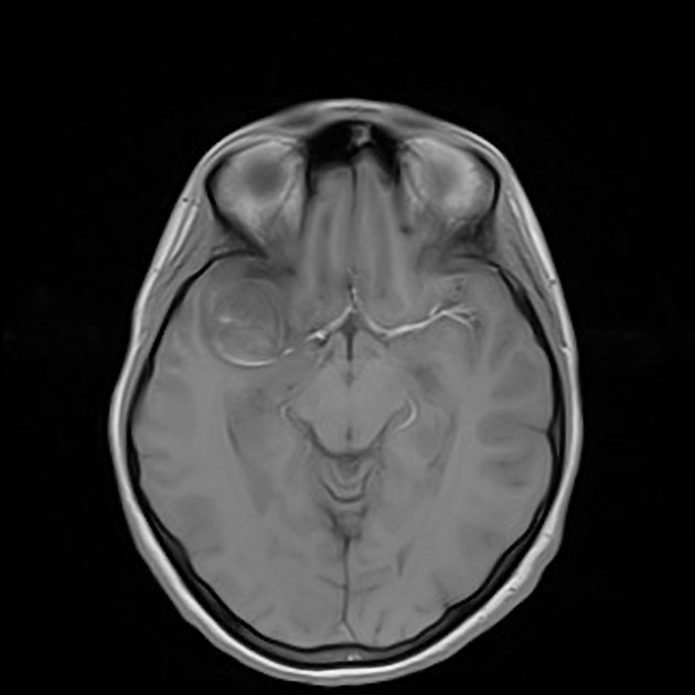 Что покажет МРТ при аневризме мозга
