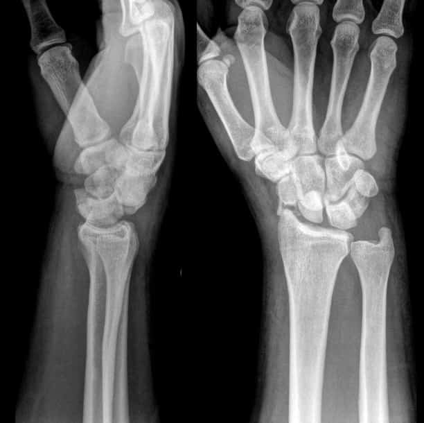 Лечение и восстановление при вывихе кисти руки