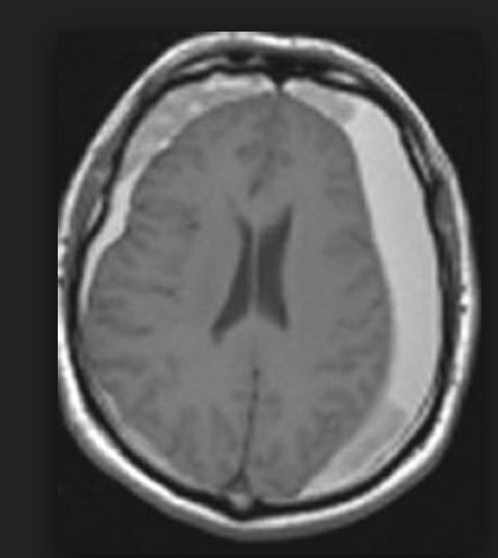 Что покажет МРТ при гематоме головного мозга