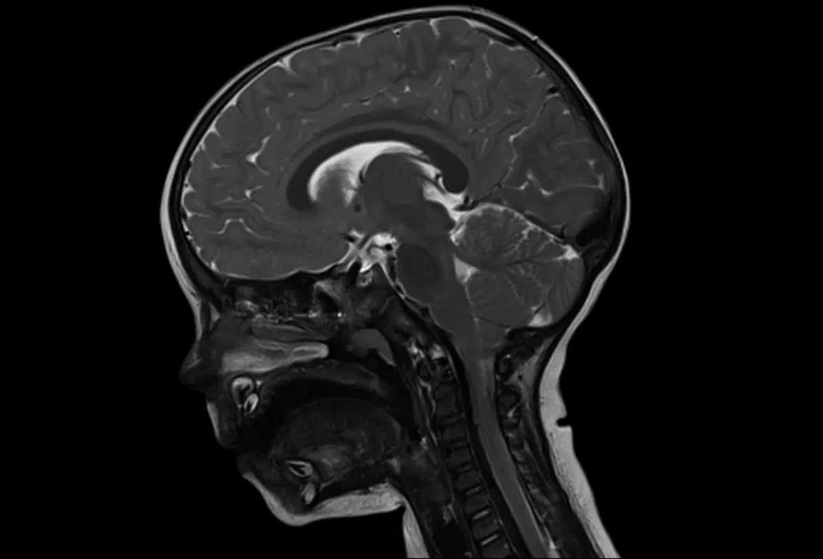 Что покажет МРТ головного мозга при аутизме