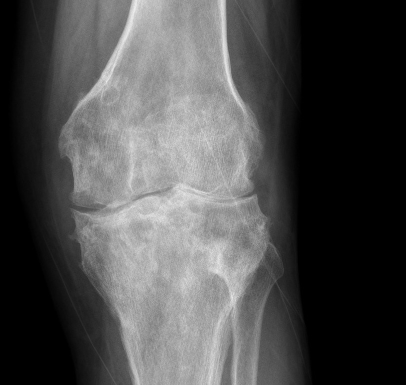 Какой врач лечит остеоартроз колена
