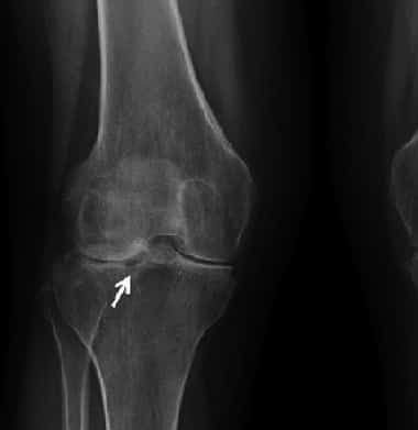 Какой врач лечит периартрит коленного сустава