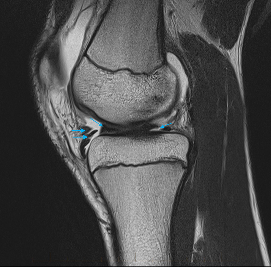 Что покажет МРТ коленного сустава (колена)