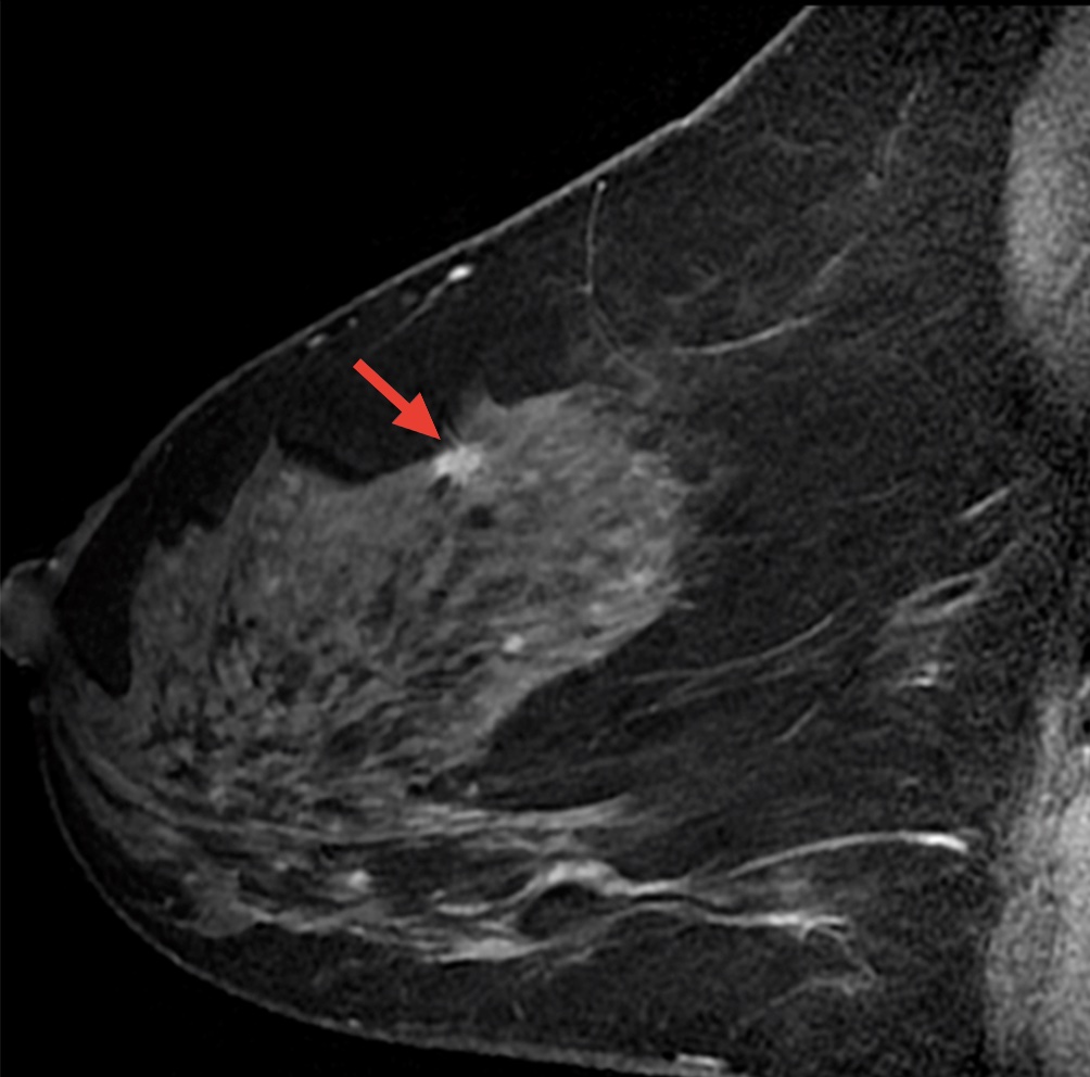 Что покажет МРТ при раке груди