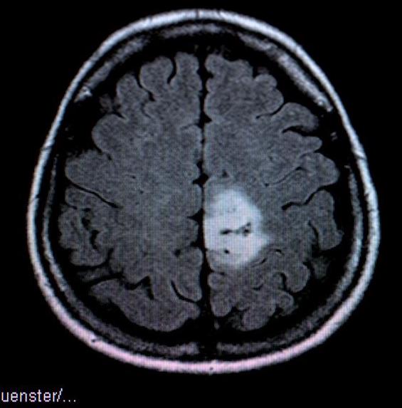 Что покажет МРТ головного мозга