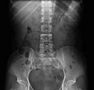 Рентген грудного отдела позвоночника