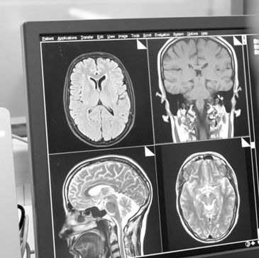 Что покажет МРТ головного мозга при кисте шишковидной железы 