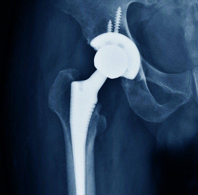 Рентген: дисплазия тазобедренных суставов (тбс) с расшифровкой