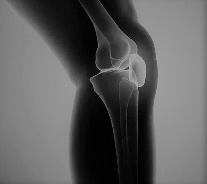 Что такое операция по замене коленного сустава - простыми словами
