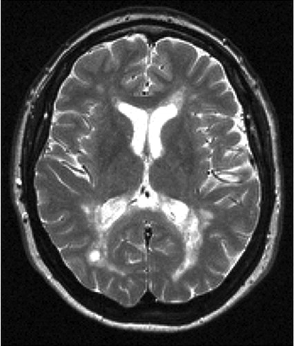 Диагностика демиелинизации головного мозга с помощью МРТ