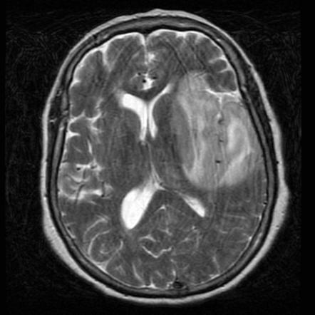 Что покажет МРТ при дисциркуляторной энцефалопатии 