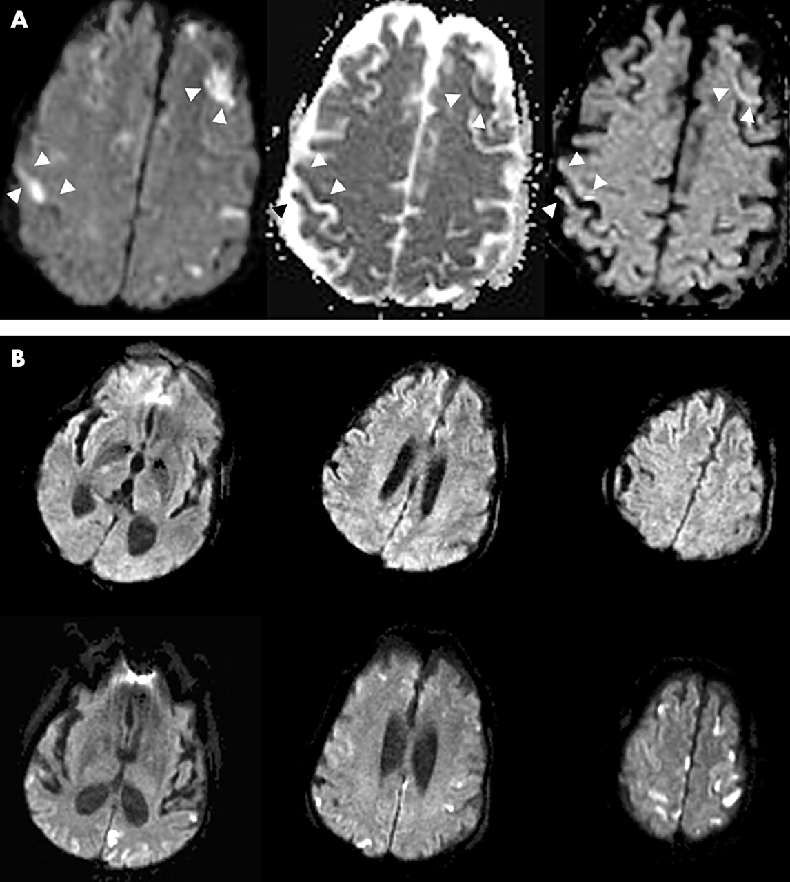 МРТ при лимфоме мозга - протокол, признаки на МРТ снимках