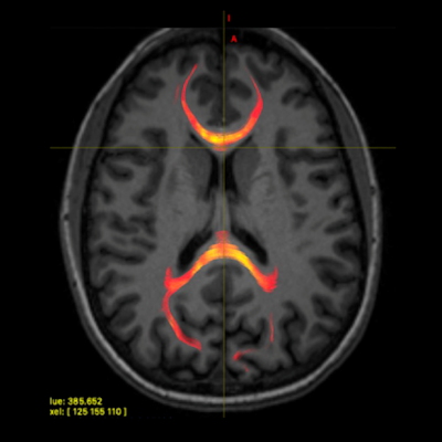 Что покажет КТ и МРТ при сотрясении головного мозга