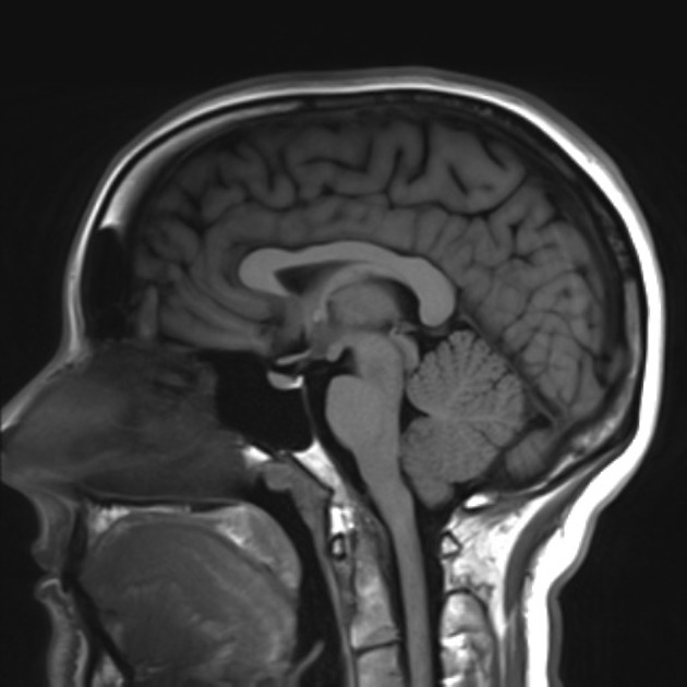 Что такое лейкоареоз при МРТ головного мозга